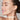 PROFHILO® TREATMENT
