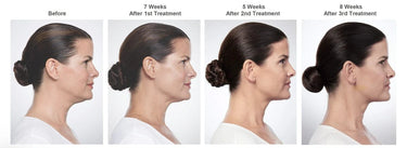 BELKYRA - FAT REDUCTION TREATMENT